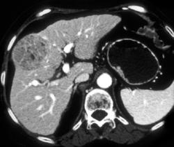 Hepatoma - CTisus CT Scan