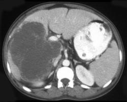 Liver Metastases Due to A Gist - CTisus CT Scan