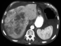 Hepatoma - CTisus CT Scan