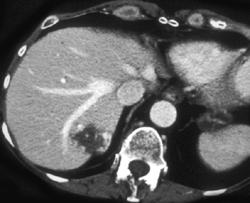 Hemangioma - CTisus CT Scan