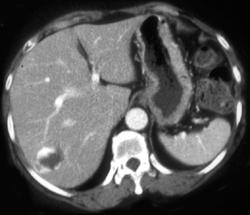 Hemangioma - CTisus CT Scan