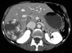 Giant Hemangioma - CTisus CT Scan