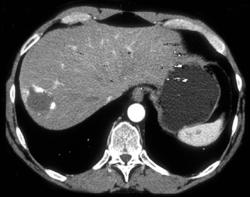 Hemangioma - CTisus CT Scan