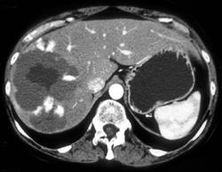 Hemangioma - CTisus CT Scan