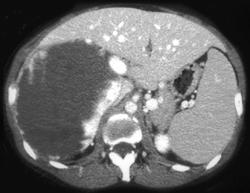 Giant Hemangioma - CTisus CT Scan