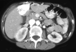 Hot Spot Due to SVC Occlusion - CTisus CT Scan