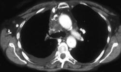 Hot Spot Due to SVC Liver - CTisus CT Scan