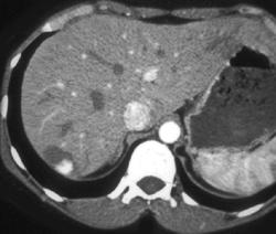 Hemangioma - CTisus CT Scan