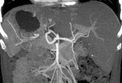 Liver Metastases - CTisus CT Scan