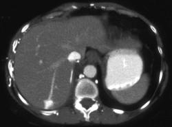 Hot Spot Liver Due to SVC Occlusion - CTisus CT Scan