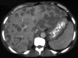 Multifocal Hepatoma - CTisus CT Scan