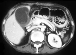 Acute Cholecystitis - CTisus CT Scan