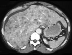 Hepatoma - CTisus CT Scan