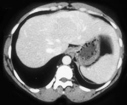 Hepatoma - CTisus CT Scan