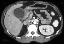 Acute Cholecystitis - CTisus CT Scan