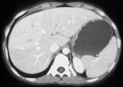 Flow Related Changes in the Liver - CTisus CT Scan