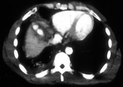 Active Bleeding in Liver Due to Trauma - CTisus CT Scan