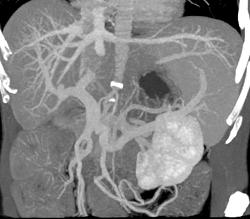 3D Hepatic Venous Anatomy - CTisus CT Scan