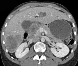 Gallbladder Cancer With Liver Metastases - CTisus CT Scan