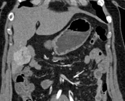 Hepatoma - CTisus CT Scan