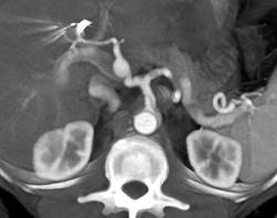 Hepatic Artery Aneurysm - CTisus CT Scan