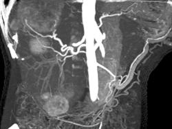 Metastatic Carcinoid - CTisus CT Scan