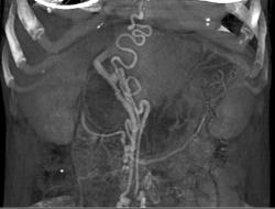 Varices in Abdominal Wall (cirrhosis) - CTisus CT Scan