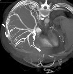 Collaterals Along Surface of the Liver in Patient With SVC Occlusion - CTisus CT Scan