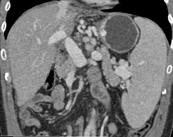 Cirrhosis With Varices - CTisus CT Scan