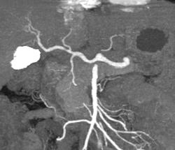 Normal Celiac Artery and SMA - CTisus CT Scan