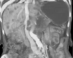 Pancreatic Cancer Invades the Inferior Vena Cava (IVC) - CTisus CT Scan