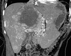 Metastatic Carcinoid Tumor - CTisus CT Scan