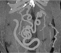 Varices - CTisus CT Scan