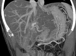 Liver Metastases- Carcinoid Tumor - CTisus CT Scan