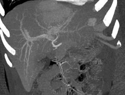 Hepatoma - CTisus CT Scan