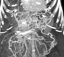 Cirrhosis With Varices - CTisus CT Scan