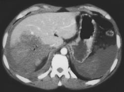 Liver Laceration - CTisus CT Scan