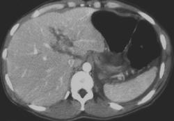 Liver Laceration - CTisus CT Scan