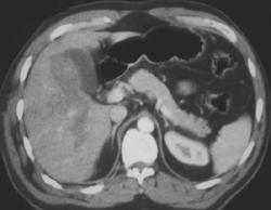 Liver Contusion and Laceration - CTisus CT Scan