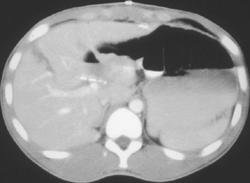 Liver Laceration - CTisus CT Scan