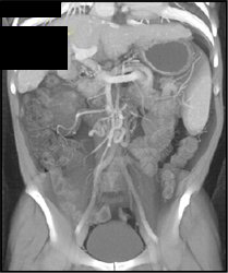 Retroperitoneal Collaterals - CTisus CT Scan