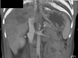 Hepatoma Invades Inferior Vena Cava (IVC) - CTisus CT Scan