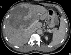 Hepatoma Presents With Spontaneous Hemorrhage - CTisus CT Scan