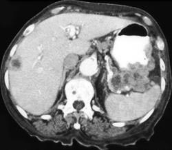 Liver Metastases From Gastric Cancer - CTisus CT Scan