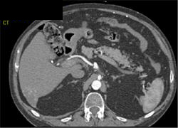 Hemangioma - CTisus CT Scan