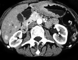 Gastric Lymphoma With Incidental Focal Nodular Hyperplasia (FNH) - CTisus CT Scan