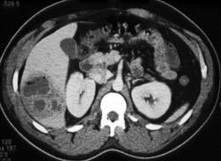 Liver Abscess - CTisus CT Scan