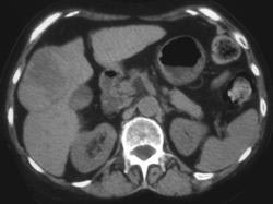 Hepatoma - CTisus CT Scan