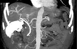 Cholangiocarcinoma - CTisus CT Scan