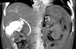 Cholangiocarcinoma - CTisus CT Scan